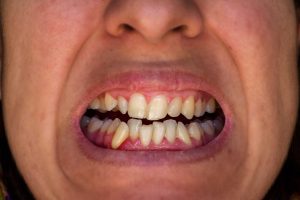 a person with crooked teeth due to teeth grinding