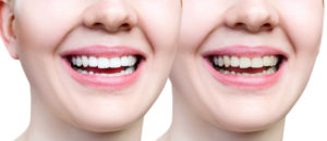 how to repair a front chipped tooth