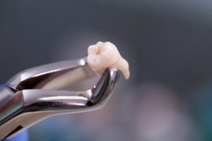 Things To Know Before Getting Wisdom Teeth Out
