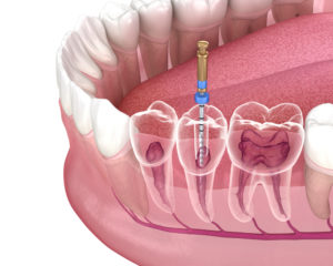 What is a Root Canal Treatment?