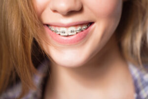 Everything You Need to Know About this Orthodontic Treatment