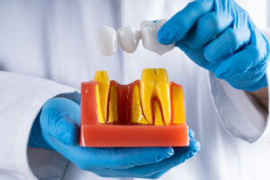 Dentist In Gloves Showing Dental Tooth Bridge Model