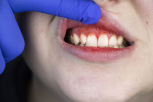 Gum Disease: A Comprehensive Overview of Causes and Consequences