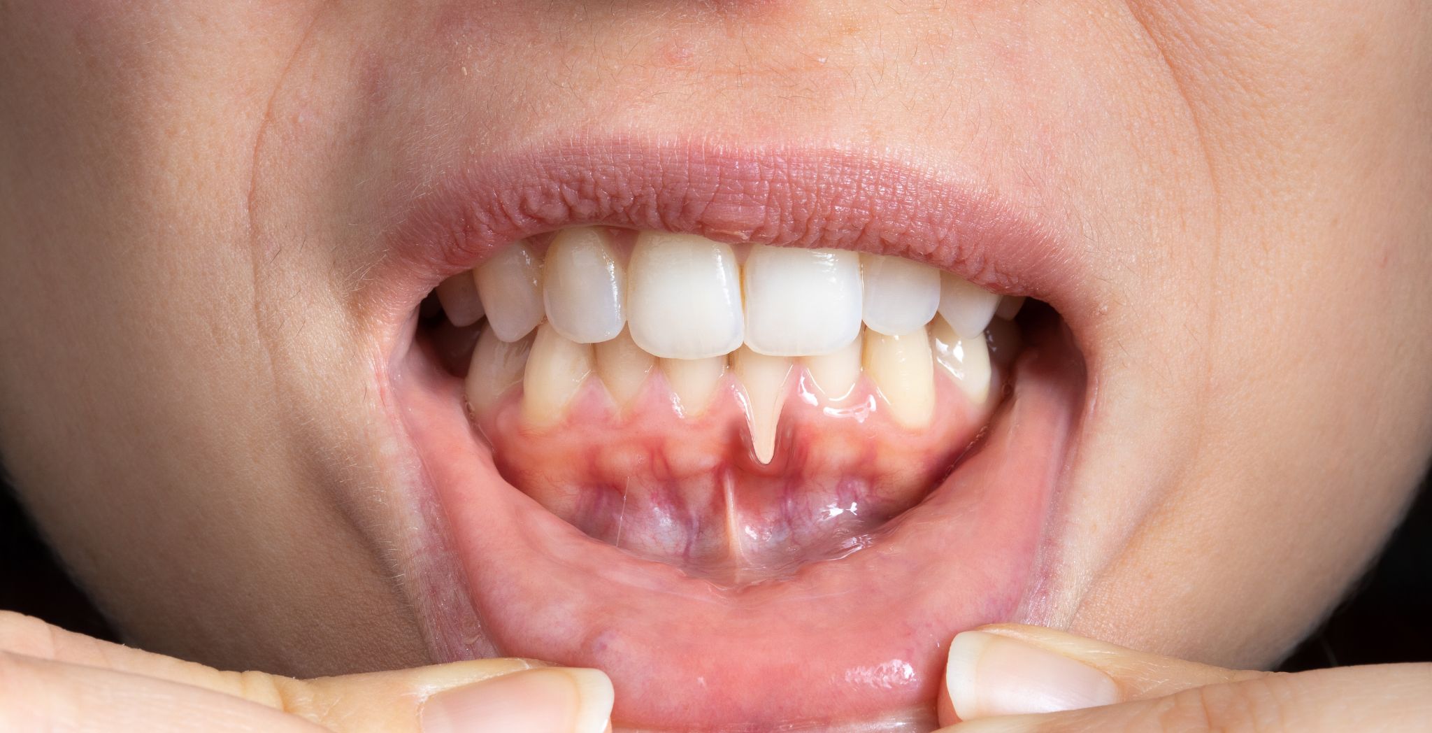 Receding gums treatment options, Gum recession remedies, How to treat receding gums, Gum graft surgery, Non-surgical gum treatment, Natural remedies for receding gums, Dental care for gum recession